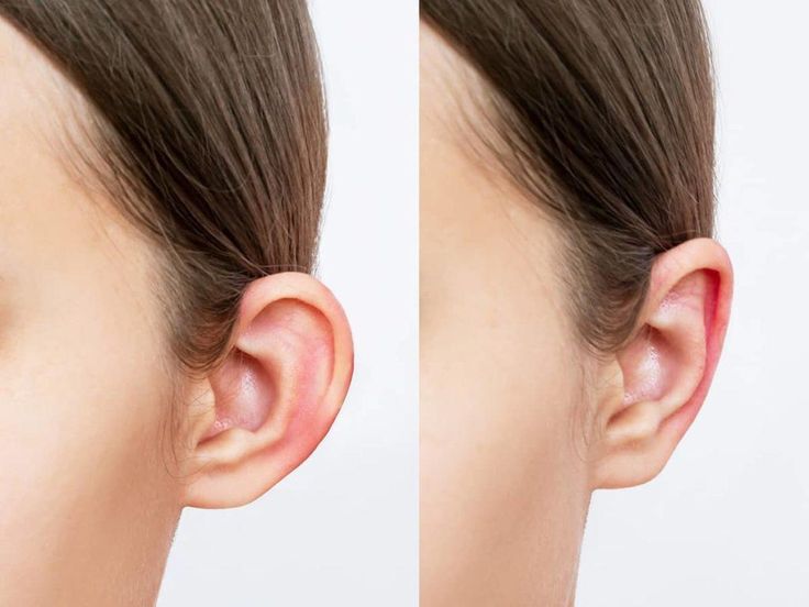 Kepçe Kulak Cerrahisi (Otoplasti)